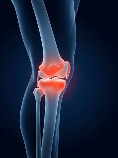 Knee Osteoarthritis